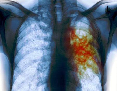 tuberculosis, TB