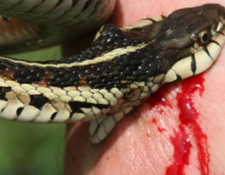 Snake bite